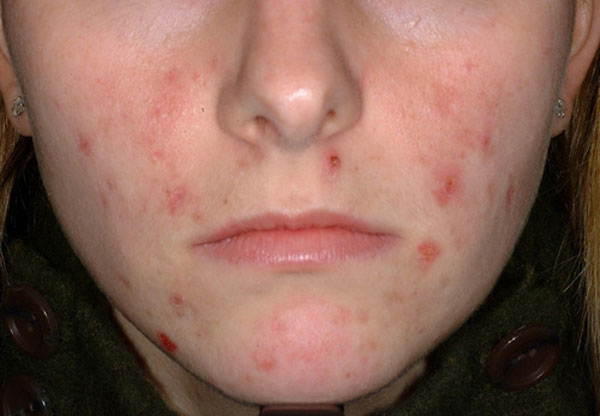 pimples-on-face